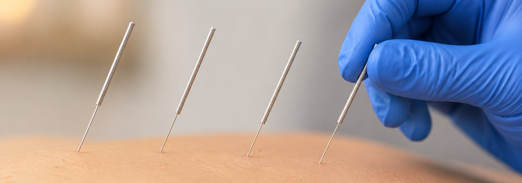 persona recibiendo tratamiento con acupuntura para dolor en palma de mallorca